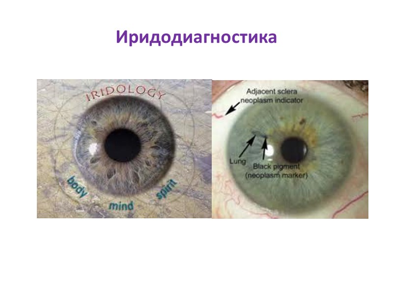 Иридодиагностика